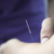 Dry Needling for Myofascial Trigger Point Pain SIMPLE